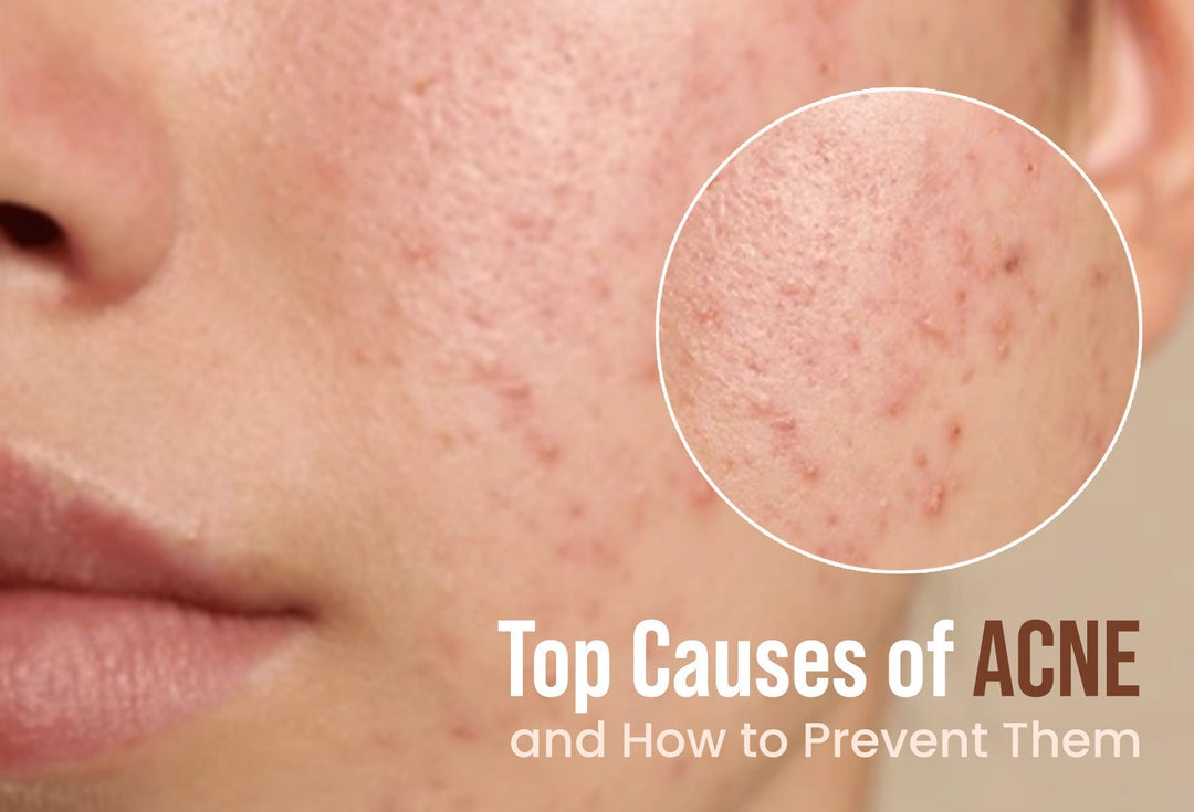 Top Causes of Acne and How to Prevent Them