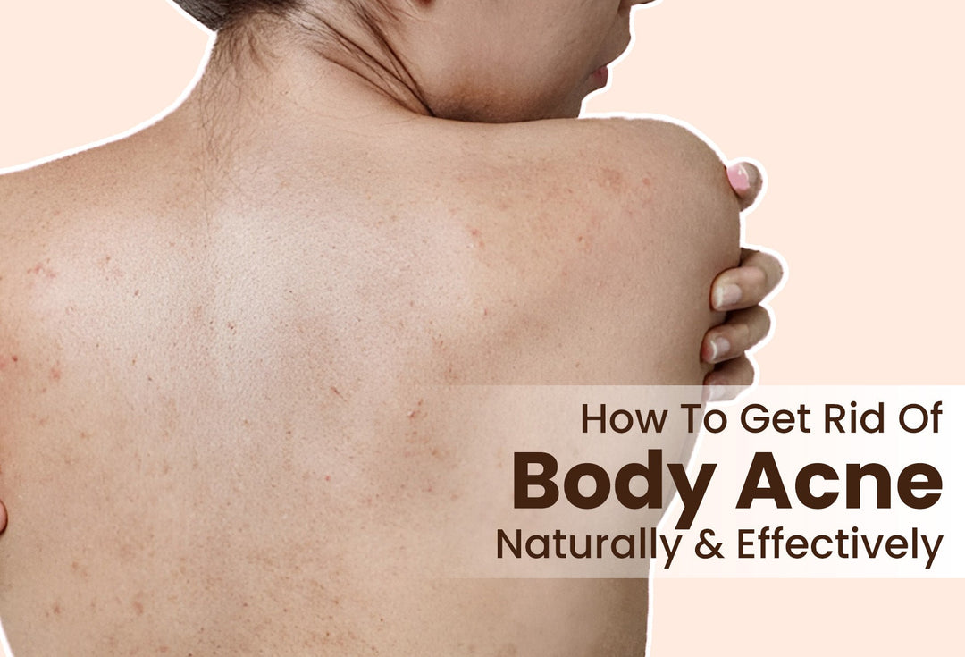 How To Get Rid Of Body Acne Naturally & Effectively