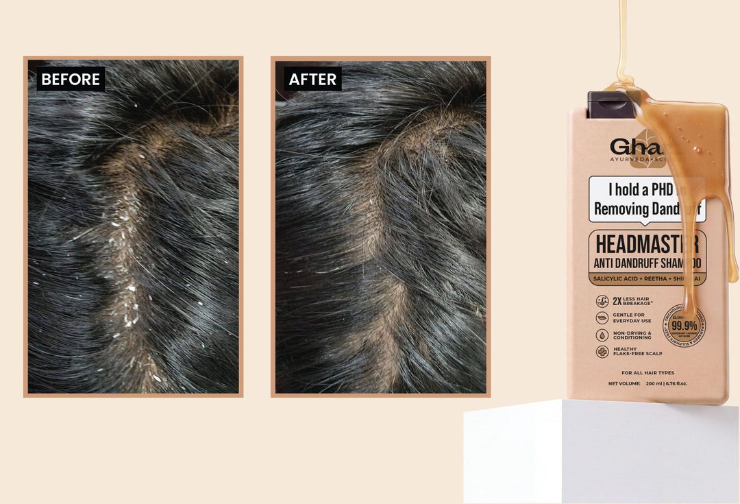 How to Get Rid of a Flaky, Dandruff-Prone Scalp: Treatment & Tips