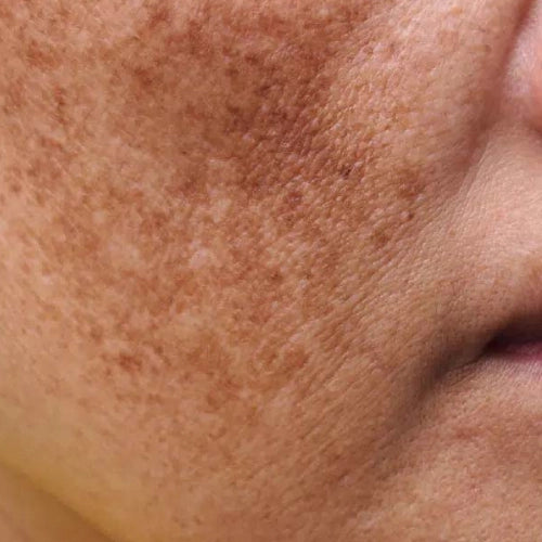 Dark spots